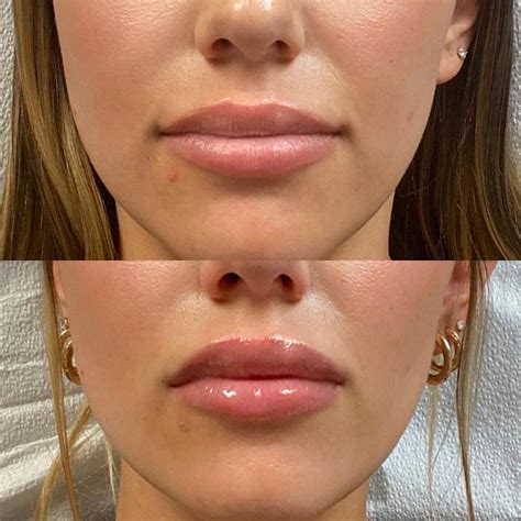 subtopic lip filler reviews.